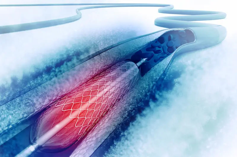 Can We Drink Alcohol After Angioplasty?