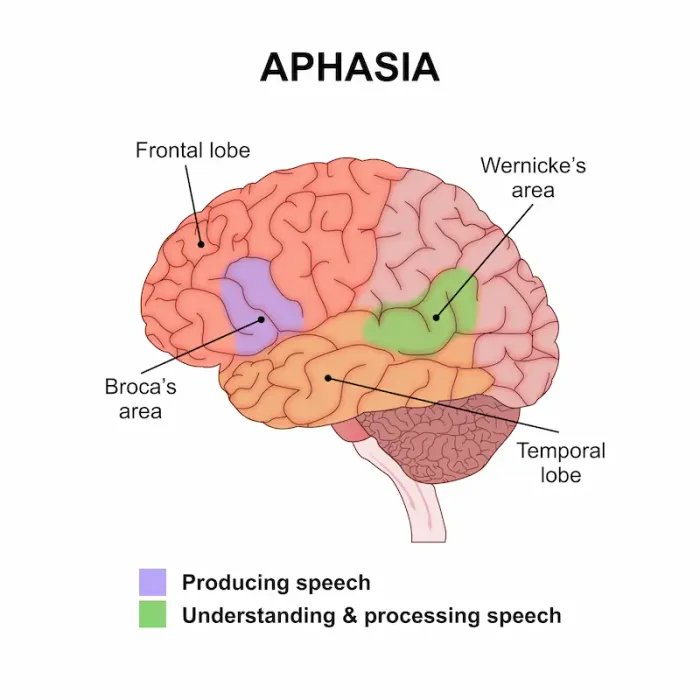 Aphasia Causes, Symptoms, Types, Treatment & Recovery Guide