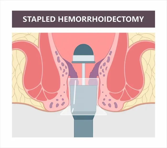 Laser Surgery for Piles Complete Guide for Faster Relief