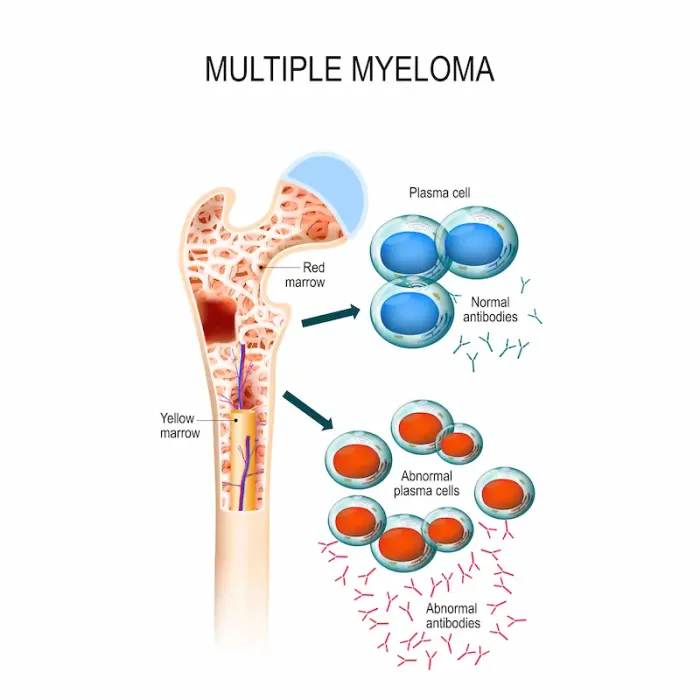 Multiple Myeloma Recognising the Signs and Understanding Your Treatment Options