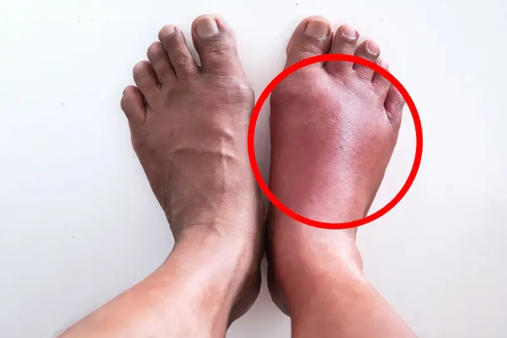 Reasons for Swelling in Feet
