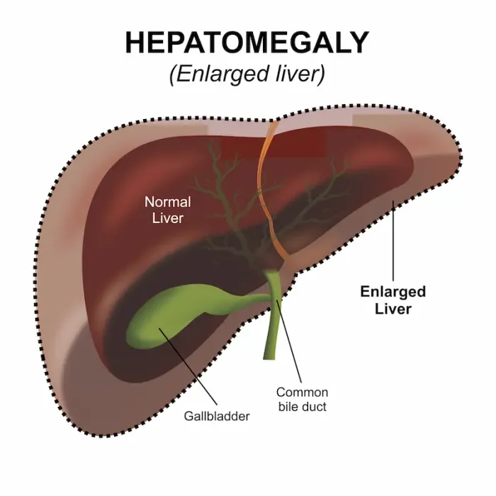 What Leads To Signs Of Hepatomegaly?