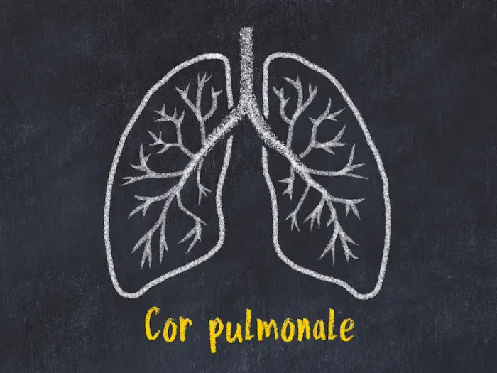 Cor Pulmonale Disease: Causes, Signs, and Diagnosis