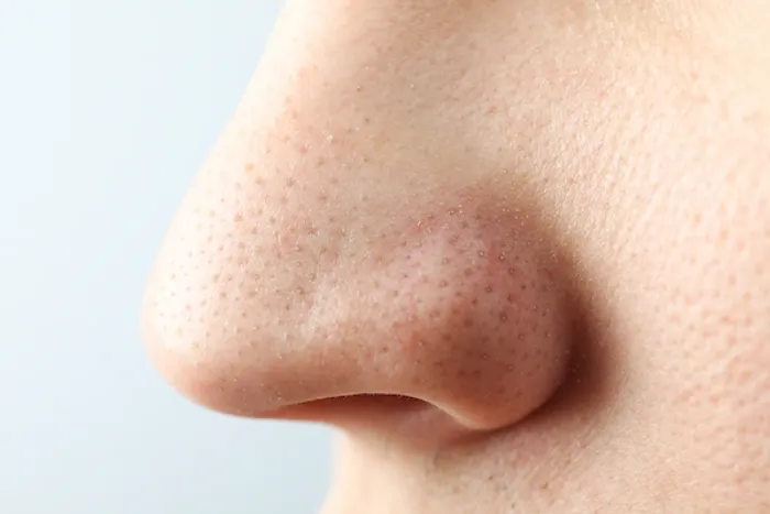 Nose Blackheads