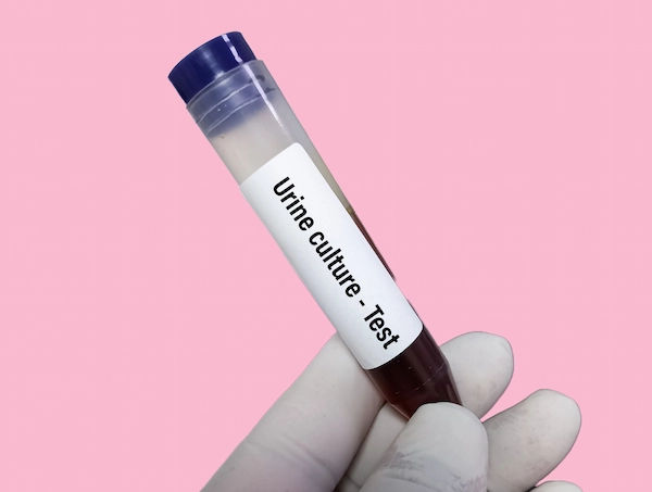Urine Culture Test