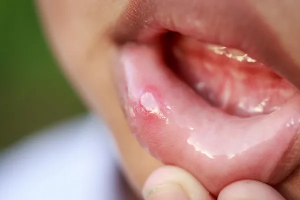 White Spots on Lips
