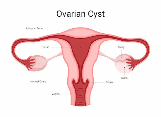 Guide to Ovarian Cyst