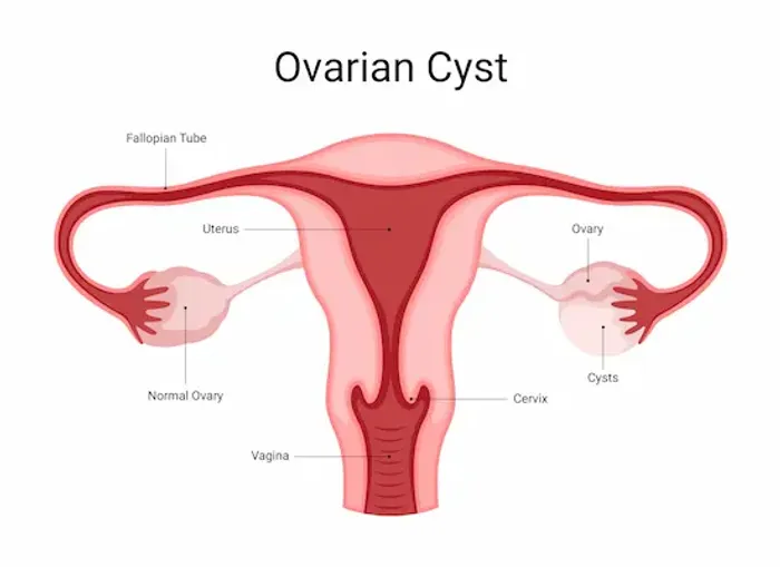 Guide to Ovarian Cyst