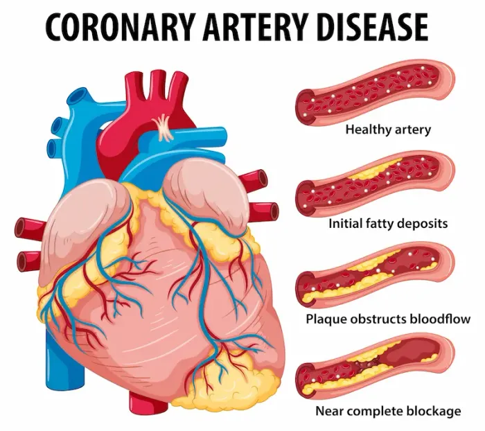 Understanding Medical Procedures for Coronary Artery Disease