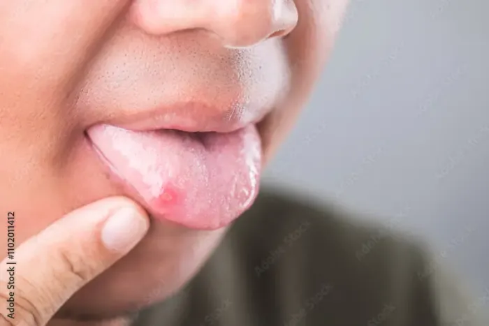 Effective Home Remedies for Tongue Ulcers and Mouth Sores