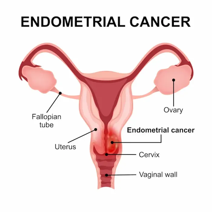 Endometrial Cancer Symptoms, Risk Factors, and Treatment Options
