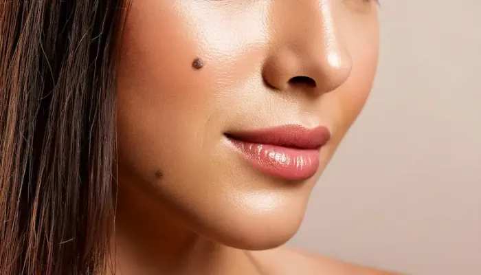 Types of Black Birthmarks Explained