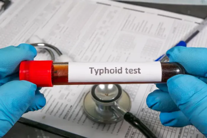 Typhoid Test Explained Procedure, Timing, and Side Effects