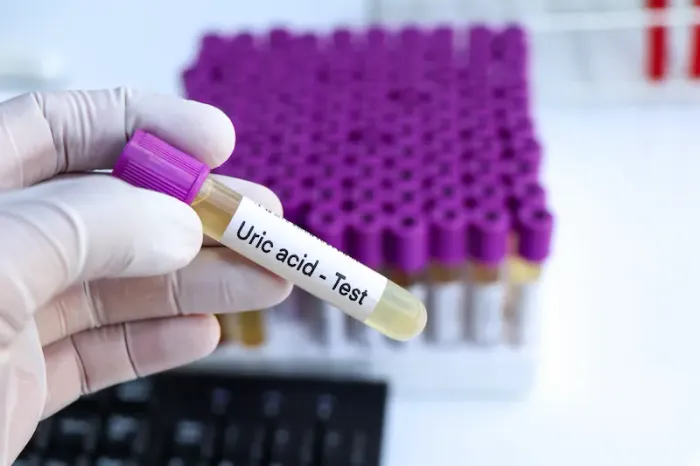 Uric Acid Test Procedure and Normal Values