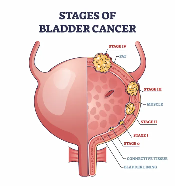 Urine Cancer Symptoms to Recognize