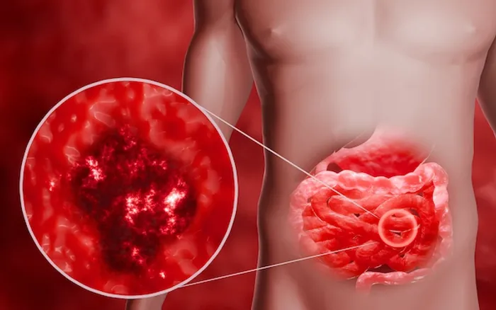 Viral Gastroenteritis