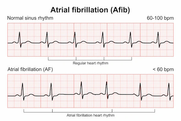 Atrial Fibrillation