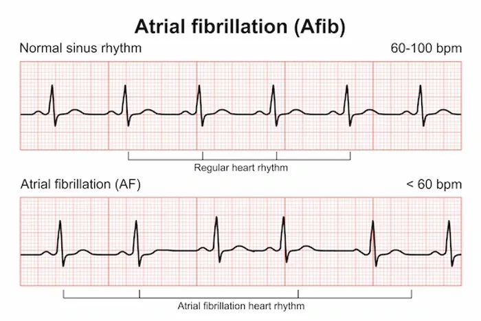 Atrial Fibrillation