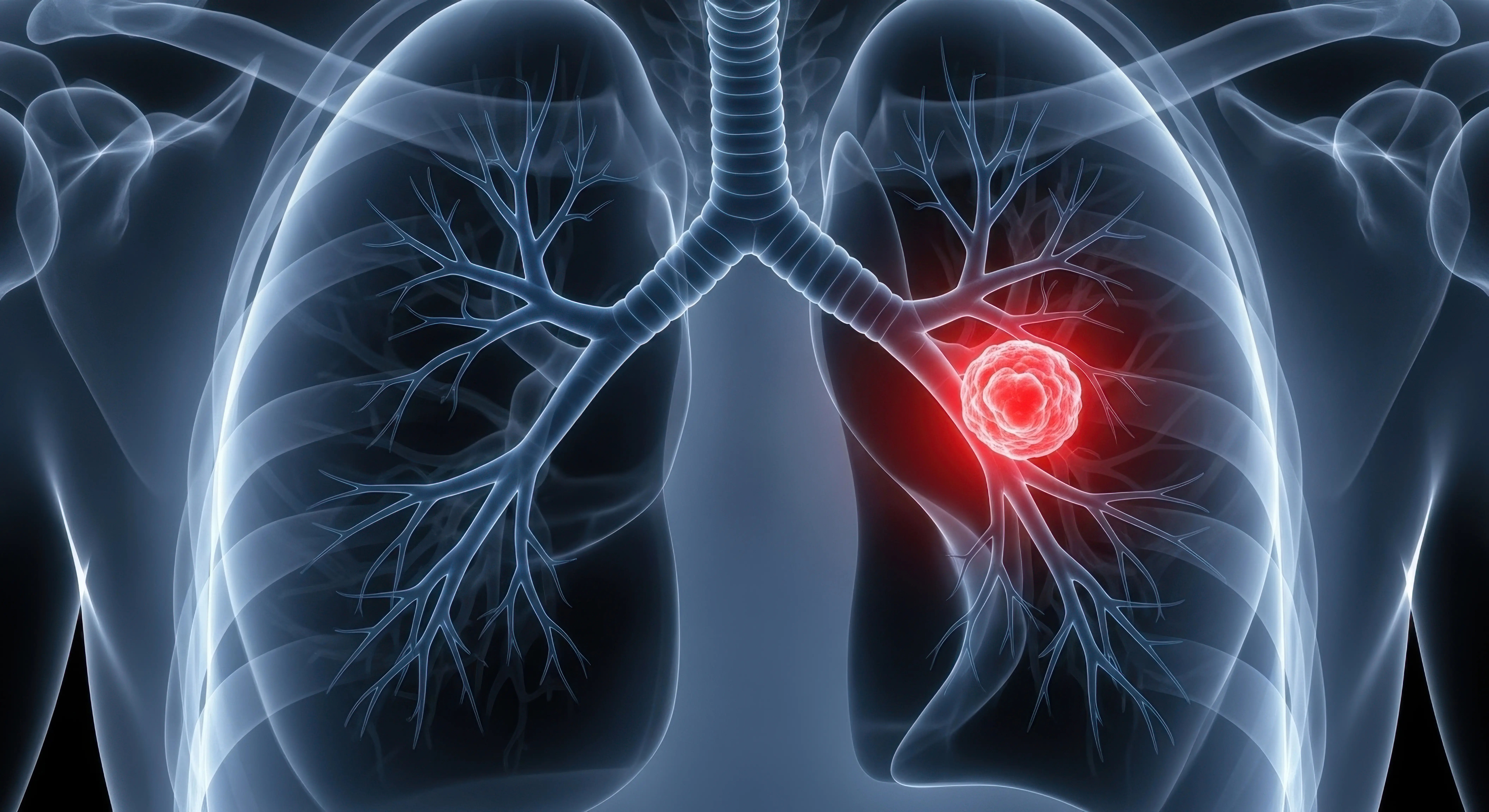 Lung Cancer Signs, Causes, Tests, and Modern Treatment Options