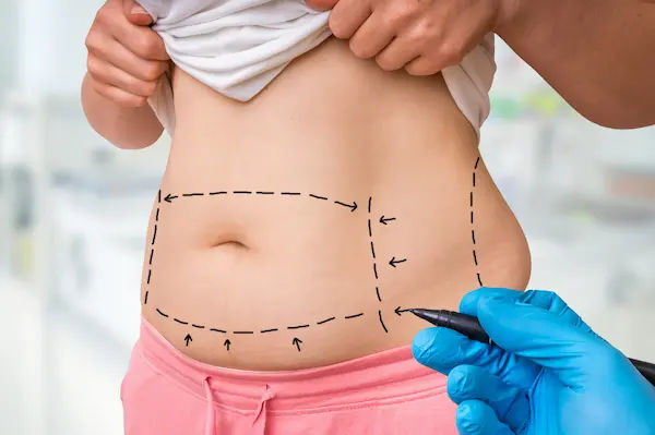 Liposuction Surgery: Key Benefits, Risks & Recovery