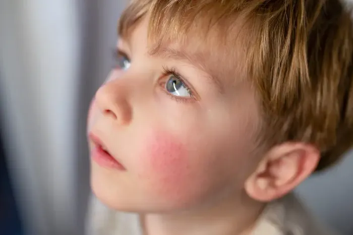 Guide to Dermatitis In Kids During Summer