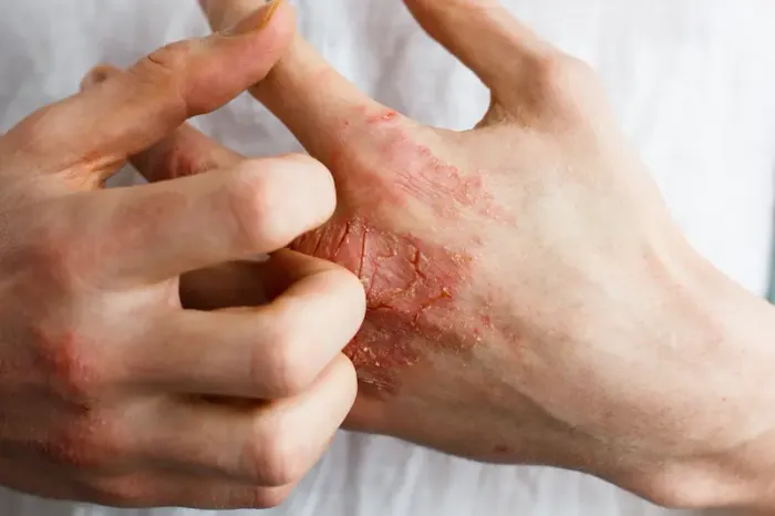 Understanding Eczema: Signs, Symptoms, and 7 Common Types