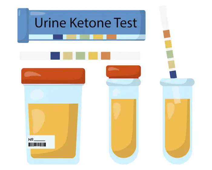 Ketones in Urine Causes, Symptoms, and When to Worry