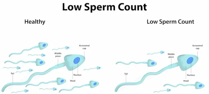Low Sperm Count Causes and Treatment