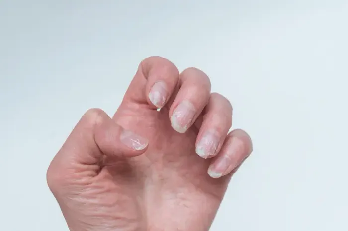 10 Causes and Risk Factors of Nail Infection