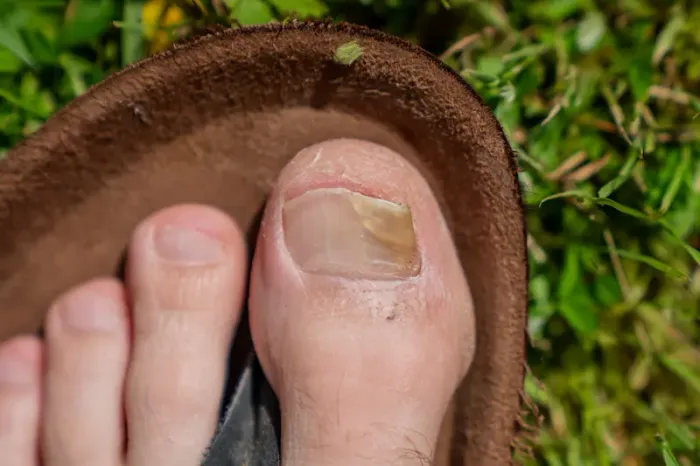 Know all about Nail Infections: Signs, Causes and Risk Factors.