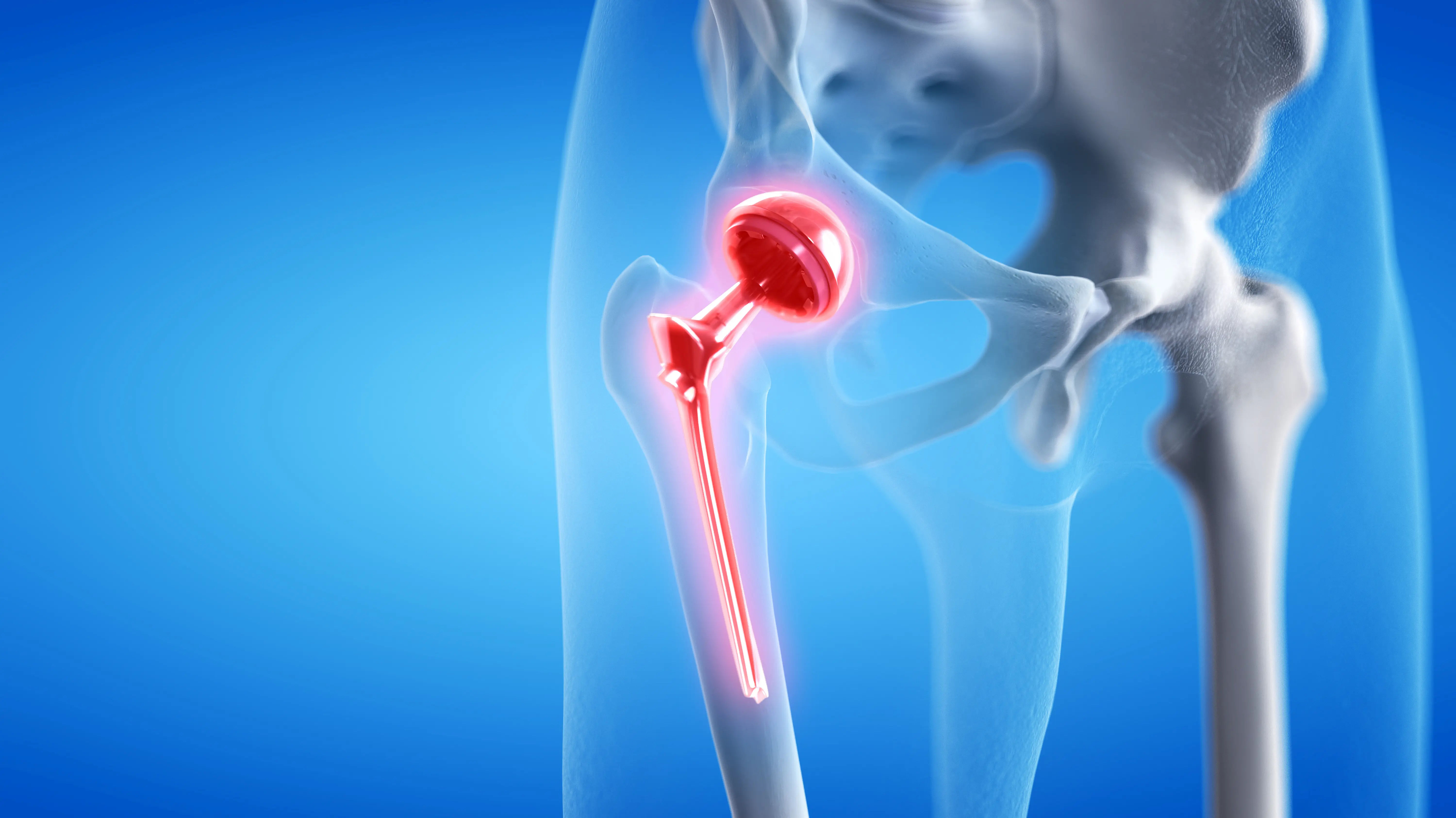 Hip Replacement Surgery Cost