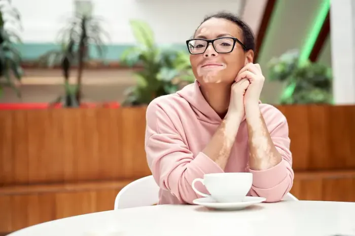 Understanding Vitiligo: Causes, Signs, and Different Types