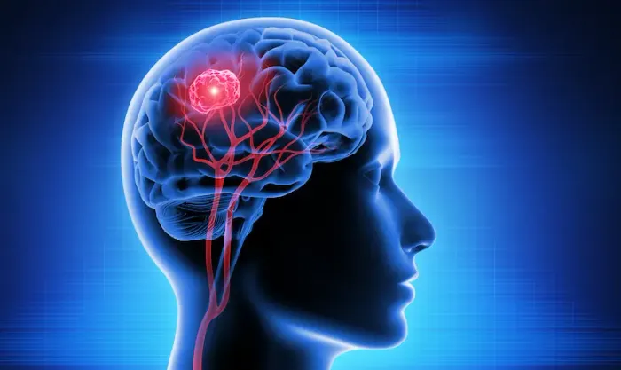 What Leads To Signs Of Brain Tumor