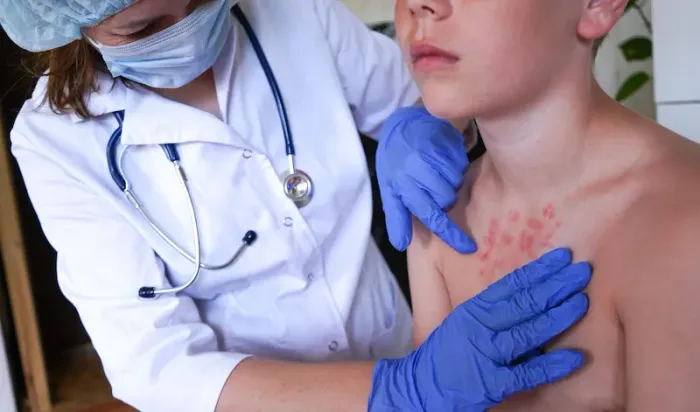 Monkeypox Signs, Treatment, and Prevention A Complete Guide