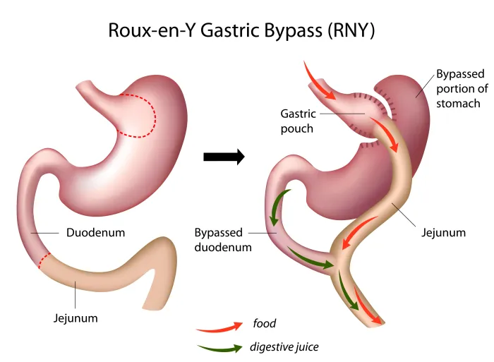 Recovery Time For Gastric Bypass Revision Surgery