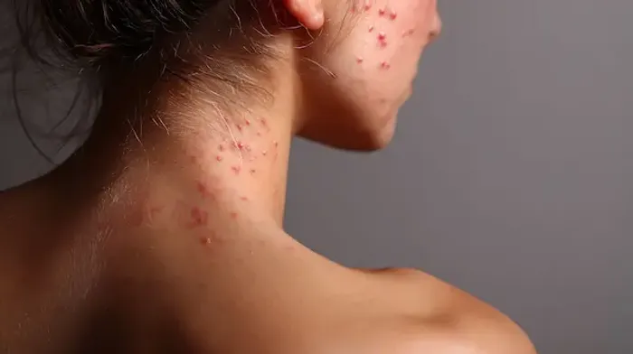 Neck Acne: Causes, Treatment And Prevention Tips For Neck Acne