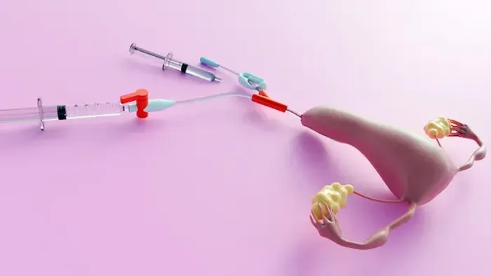 Understanding IUI: Risks, Success Rates And Uses