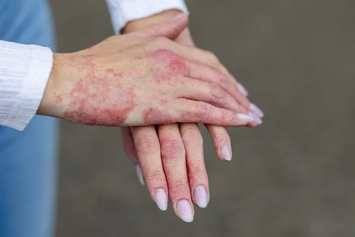 Hand Eczema: Causes, Types And Symptoms Of Hand Eczema