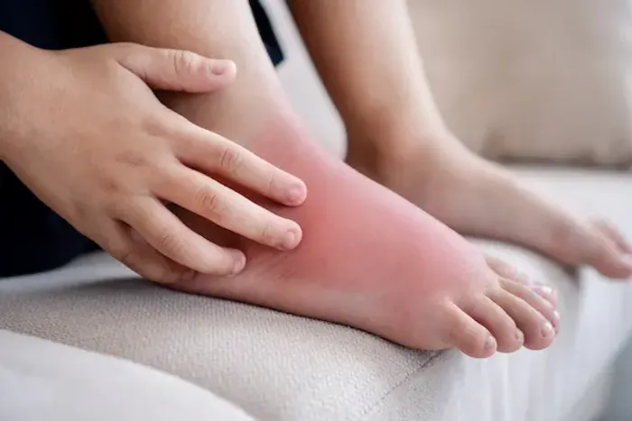 How to Reduce Swelling In Feet?