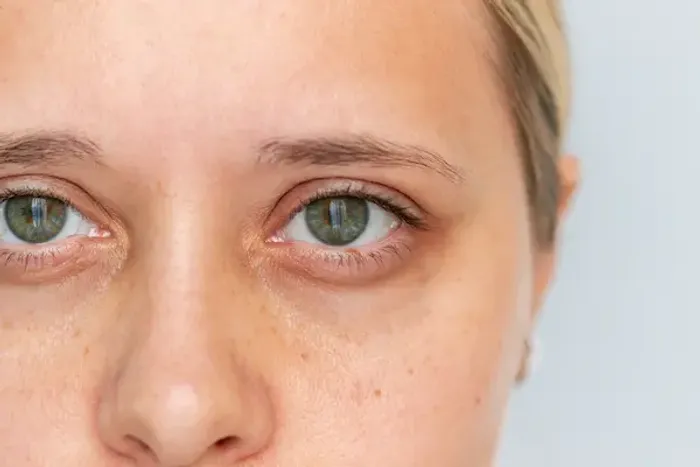 Under-Eye Wrinkles: Causes, Prevention, and Effective Solutions