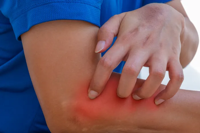 Does Psoriasis Spread?