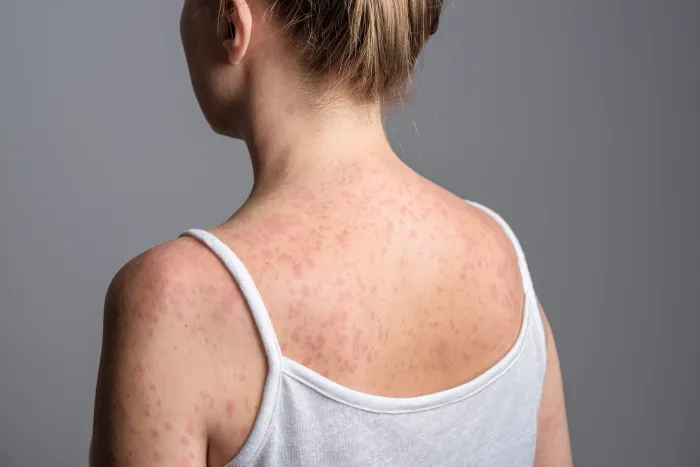 Is Psoriasis Contagious? Common Misconceptions And Facts Explained