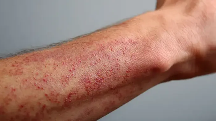 Psoriasis on Face: Causes, Symptoms, and How to Manage It