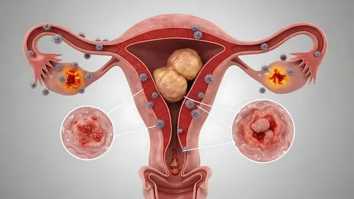 Common Symptoms of Uterine Cancer: Early Warning Signs to Watch For