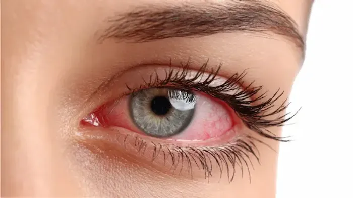 Common Eye Diseases