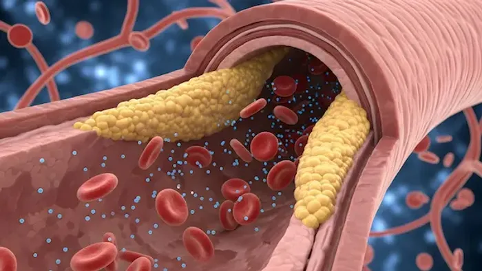 Treatment Option for Heart Disease