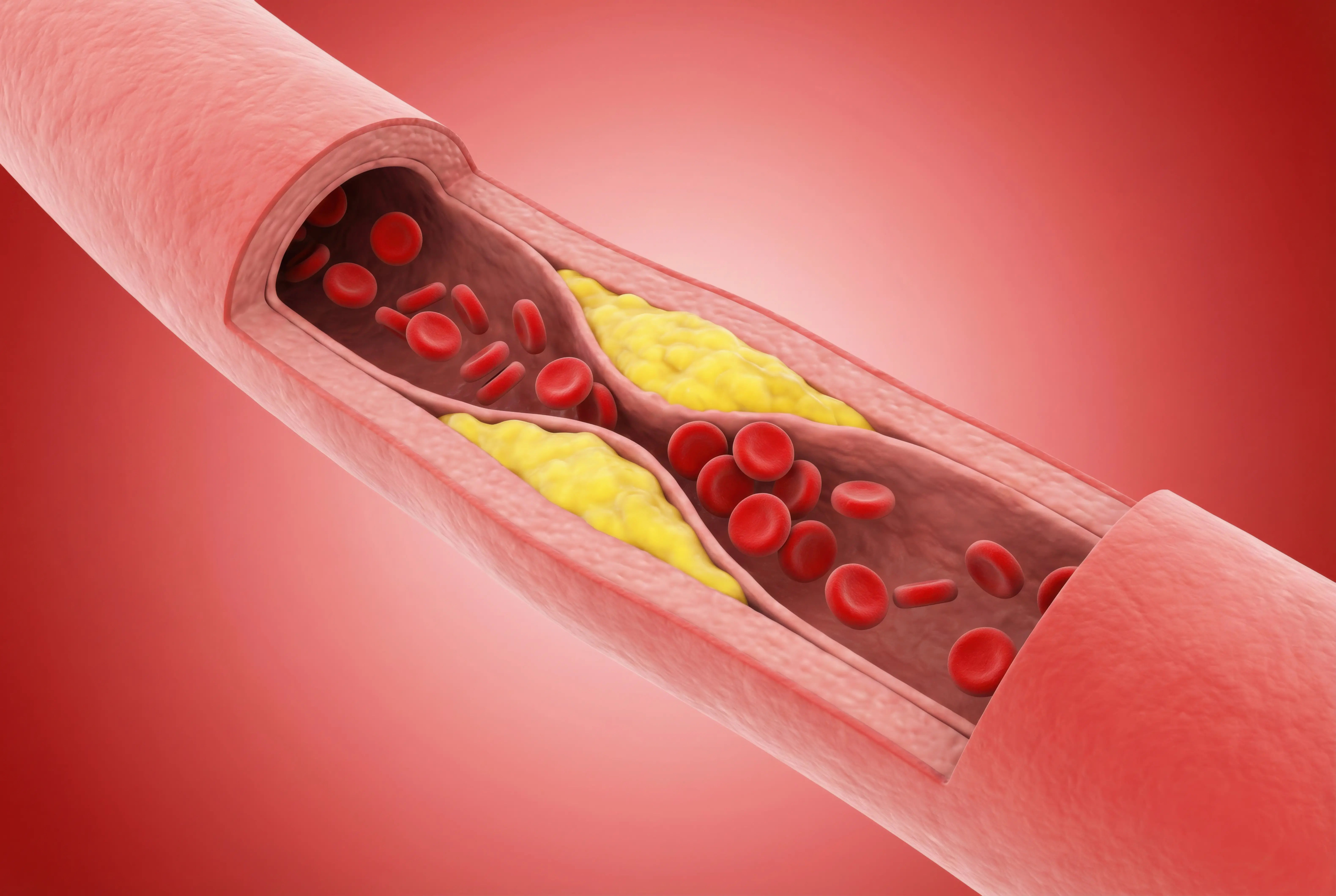 What Is Rotablation Angioplasty? An Innovative Solution For Complex Coronary Artery Disease
