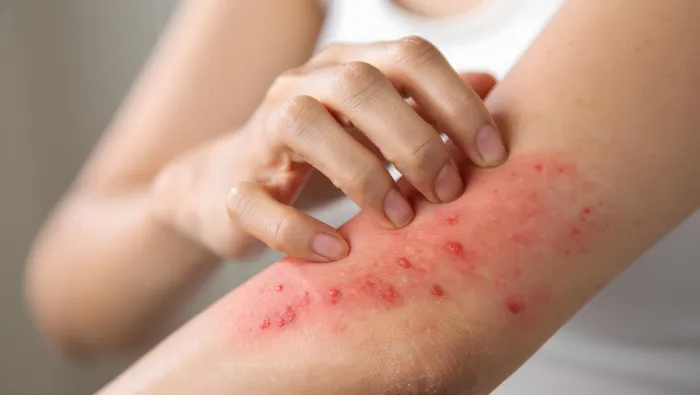 Skin Allergies:Understanding Causes, Types And Treatments