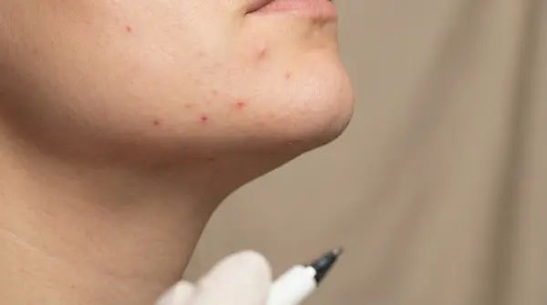 Understanding and Managing Jawline Acne