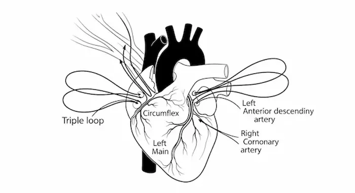 Triple Vessel Disease Of The Heart: Causes, Symptoms And Treatment